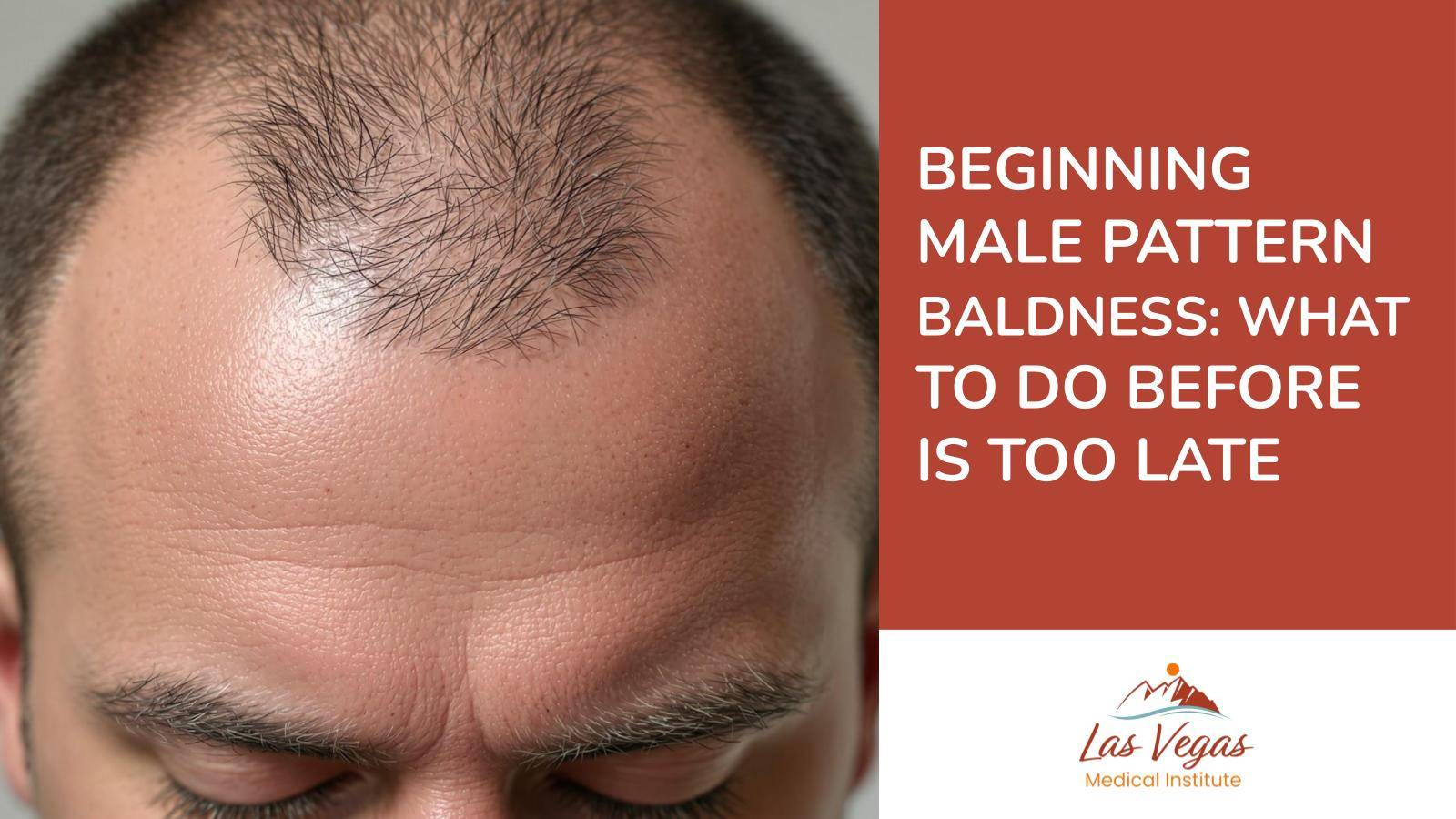 Beginning Male Pattern Baldness: What to Do Before is Too Late by Las Vegas Medical Institute