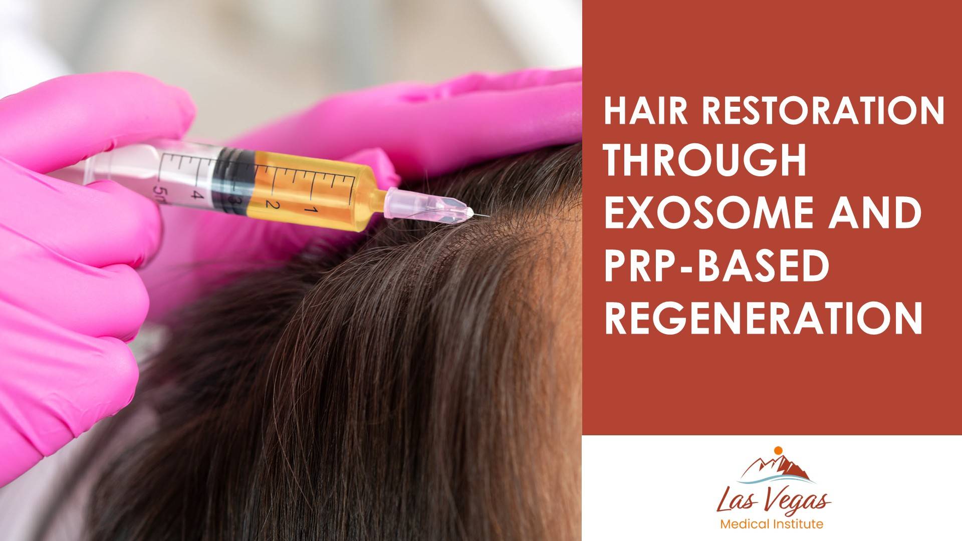 Hair Restoration Through Exosome And PRP Based Regeneration