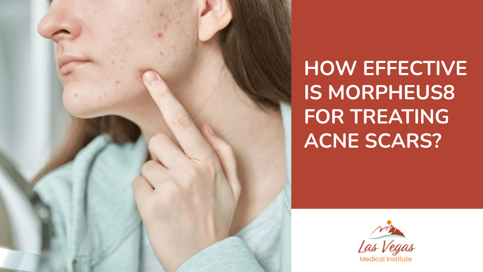 How Effective Is Morpheus8 for Treating Acne Scars? by Las Vegas Medical Institute