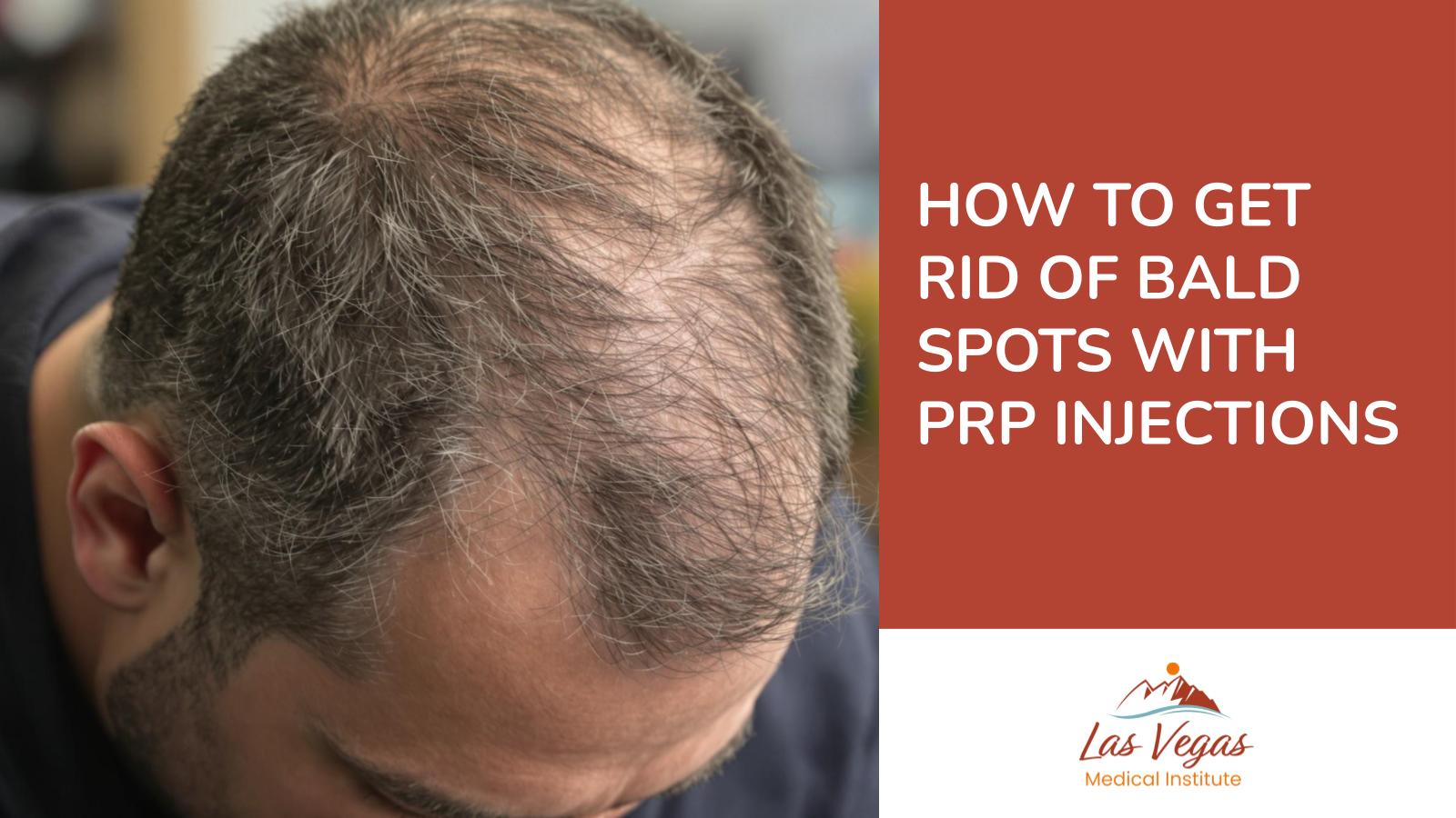 How To Get Rid Of Bald Spots With PRP Injections