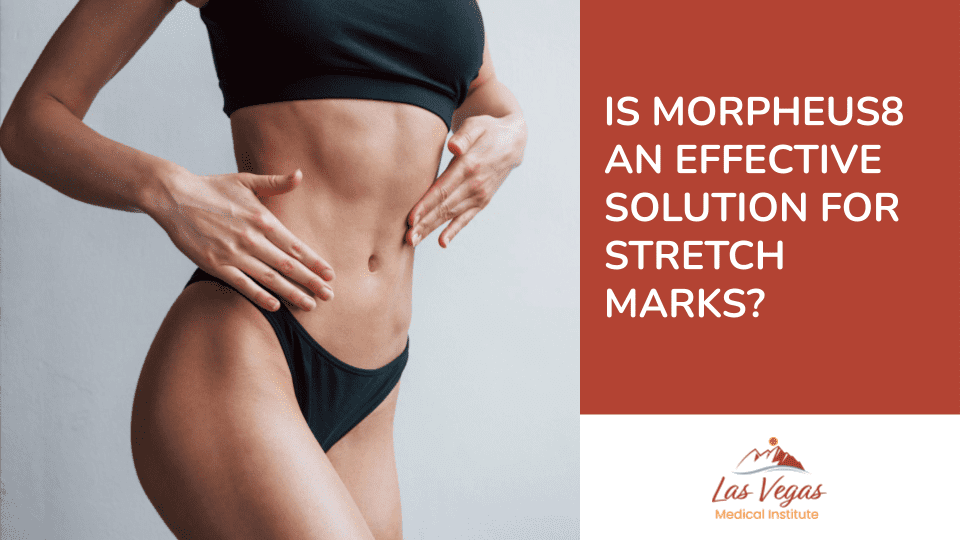 Is Morpheus  An Effective Solution For Stretch Marks?
