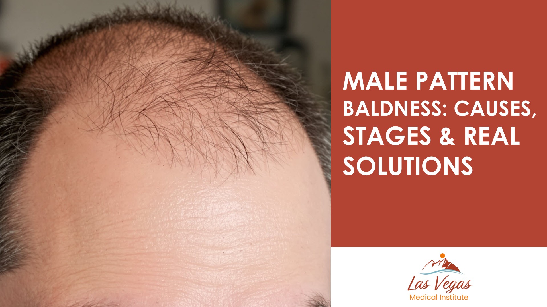 Male Pattern Baldness: Causes, Stages & Real Solutions