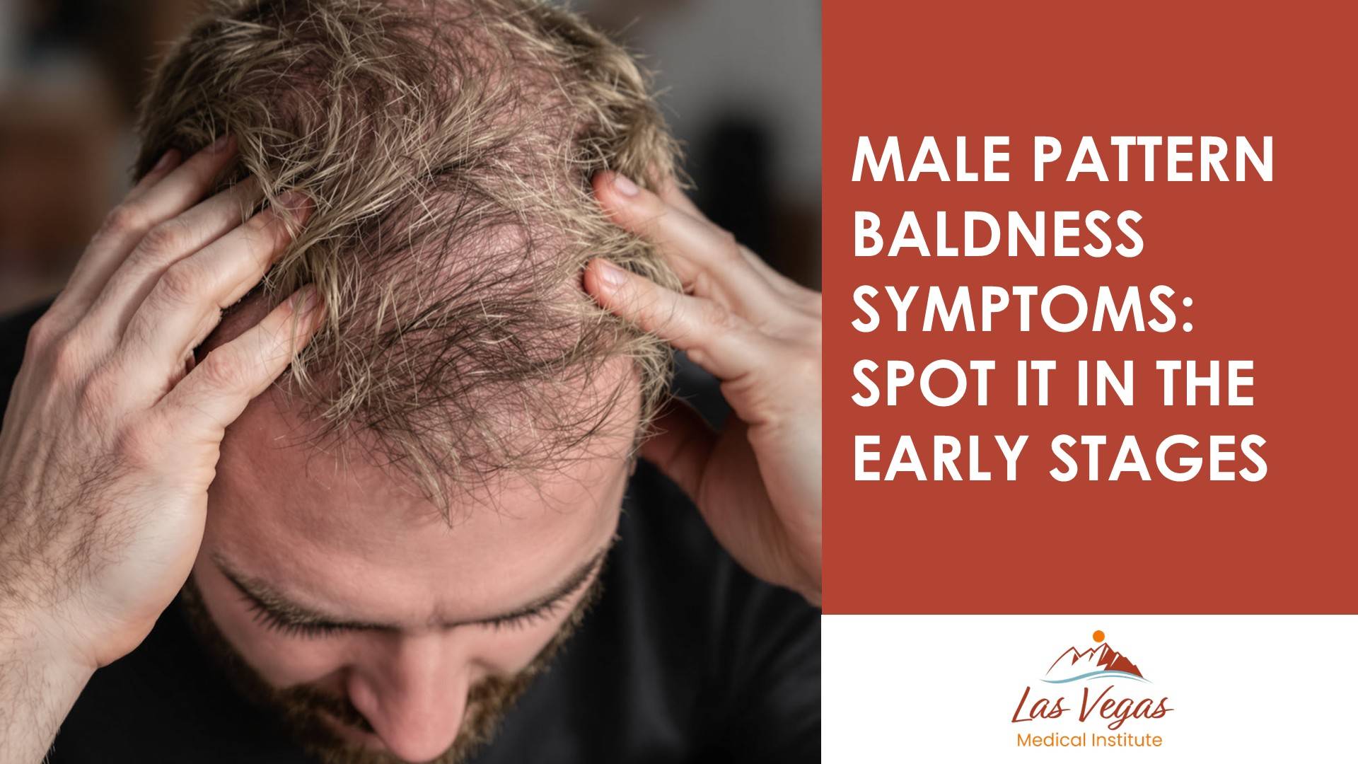 Male Pattern Baldness Symptoms: Spot It In The Early Stages