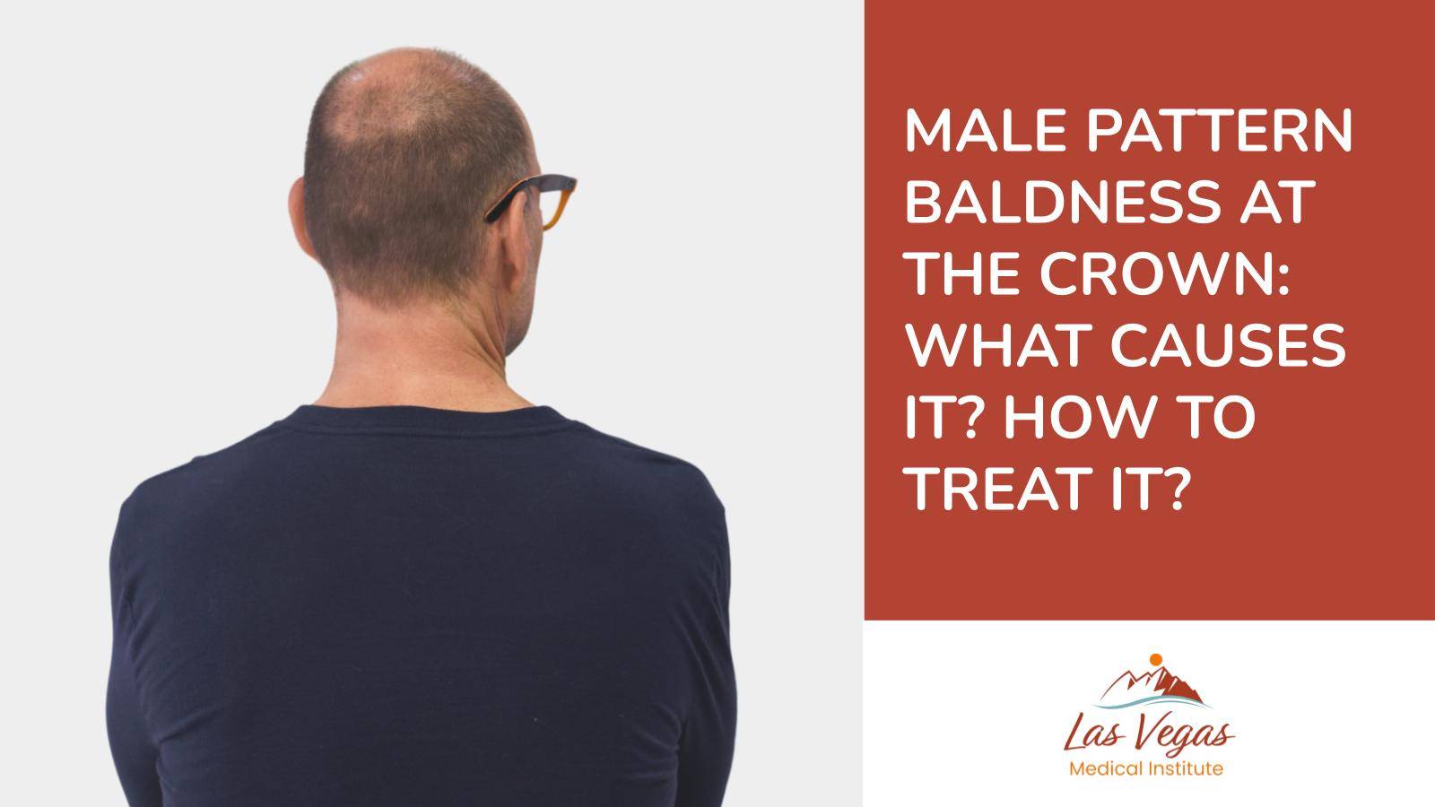Male Pattern Baldness at the Crown: What Causes it? How to Treat it? By Las Vegas Medical Institute