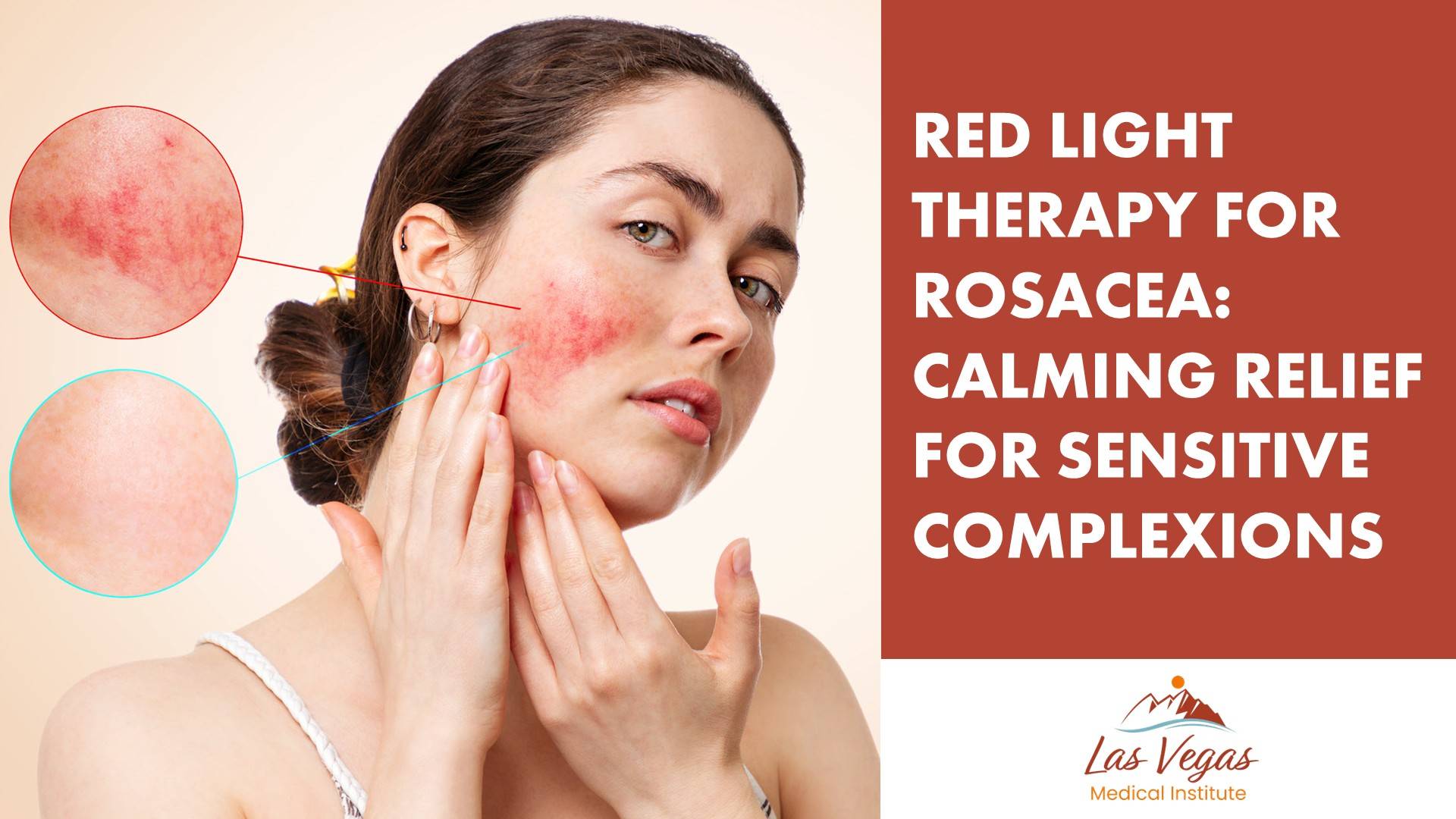 Red Light Therapy for Rosacea: Calming Relief for Sensitive Complexions By Las Vegas Medical Institute