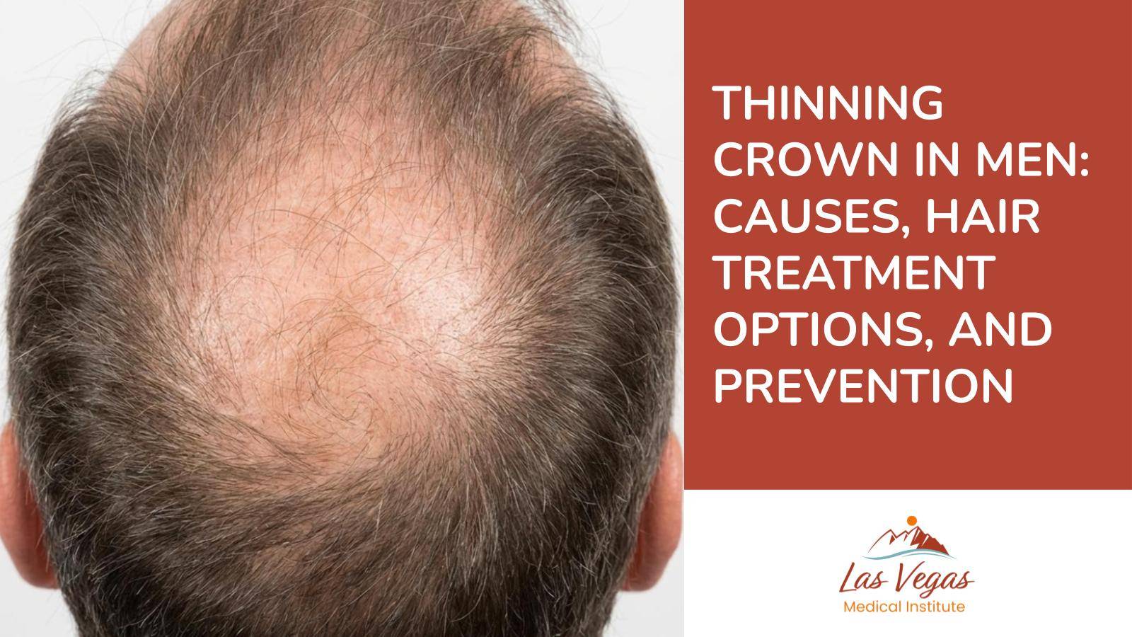 Thinning Crown in Men: Causes, Hair Treatment Options, and Prevention By Las Vegas Medical Institute
